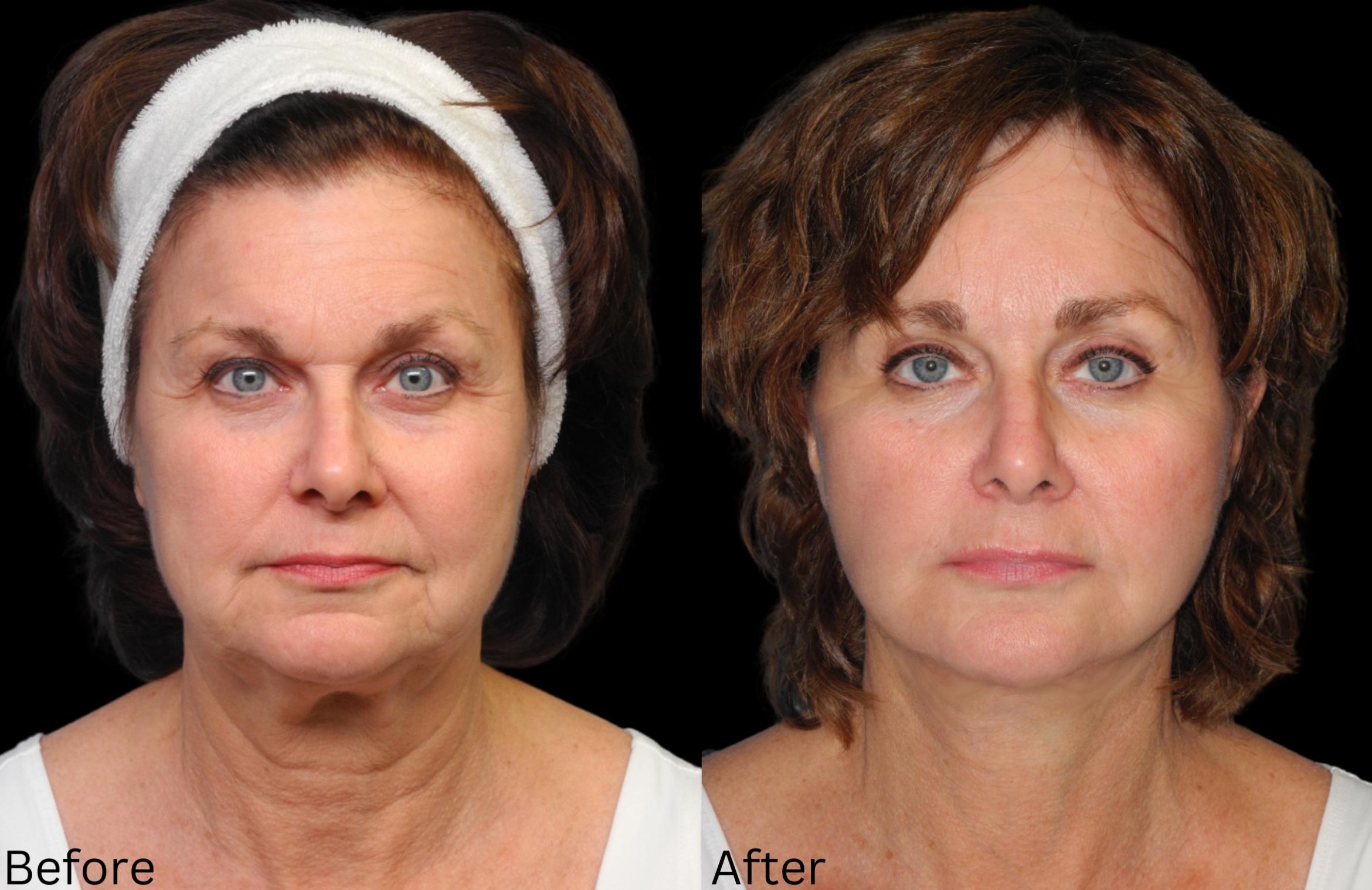 Before & After Facelift & Neck Lift Case 52 View 1 View in Santa Rosa, California