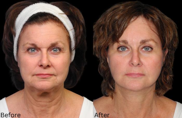 Before & After Facelift & Neck Lift Case 52 View 1 View in Santa Rosa, California