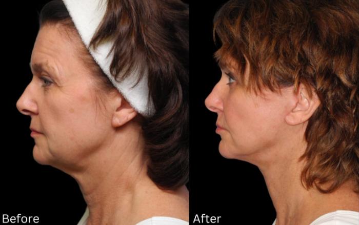 Before & After Facelift & Neck Lift Case 52 View 2 View in Santa Rosa, California