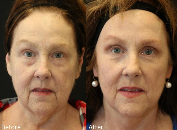 Before & After Facelift & Neck Lift Case 53 View 1 View in Santa Rosa, California