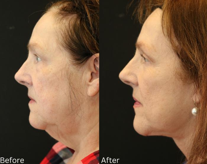 Before & After Facelift & Neck Lift Case 53 View 2 View in Santa Rosa, California
