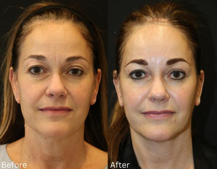 Before & After Facelift & Neck Lift Case 54 View 1 View in Santa Rosa, California