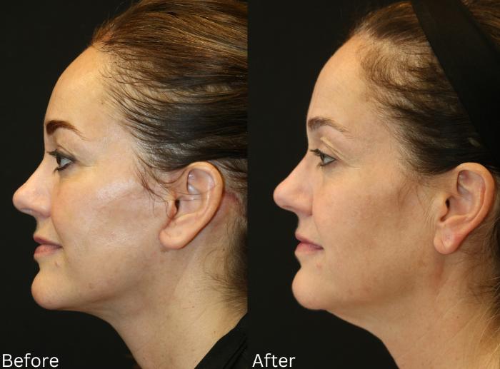 Before & After Facelift & Neck Lift Case 54 View 2 View in Santa Rosa, California