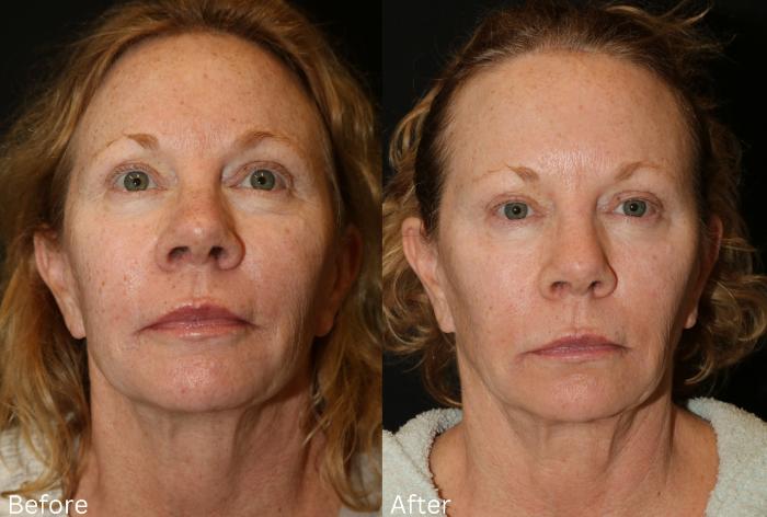 Before & After Fractionated CO2 (DOT) Laser Case 126 View 1 View in Santa Rosa, California
