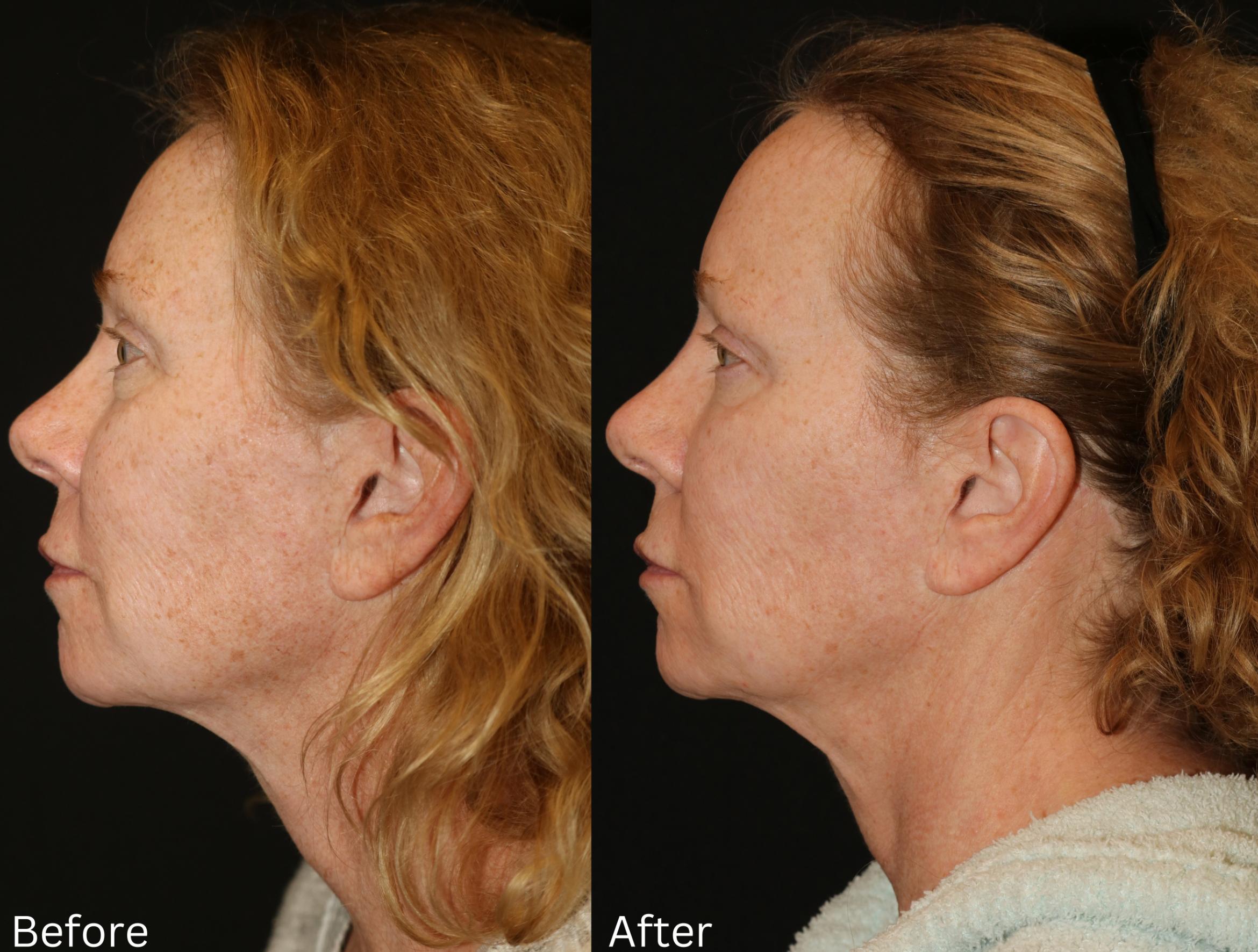 Before & After Fractionated CO2 (DOT) Laser Case 126 View 2 View in Santa Rosa, California