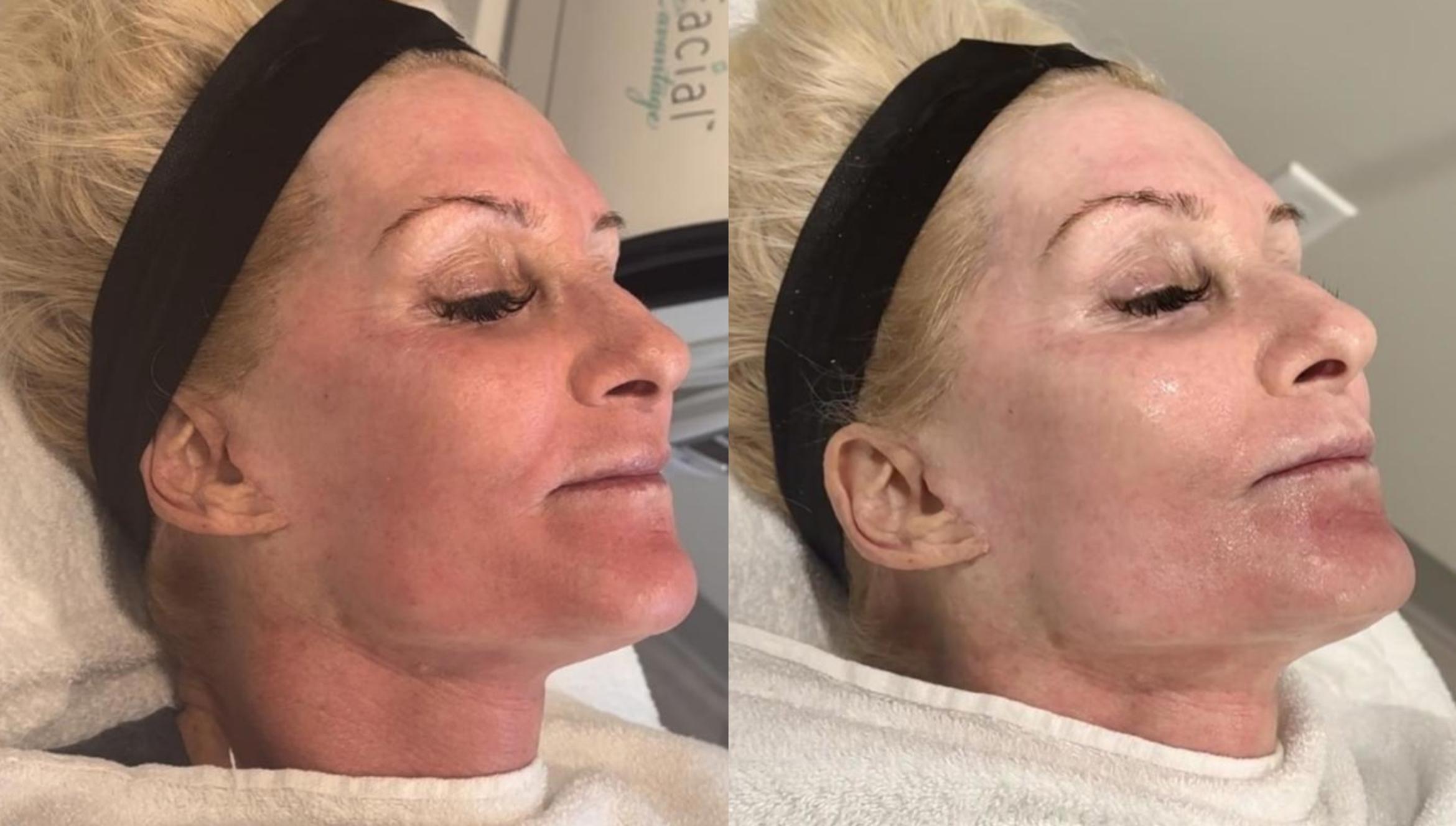 Before & After Fractionated CO2 (DOT) Laser Case 181 View 1 View in Santa Rosa, California