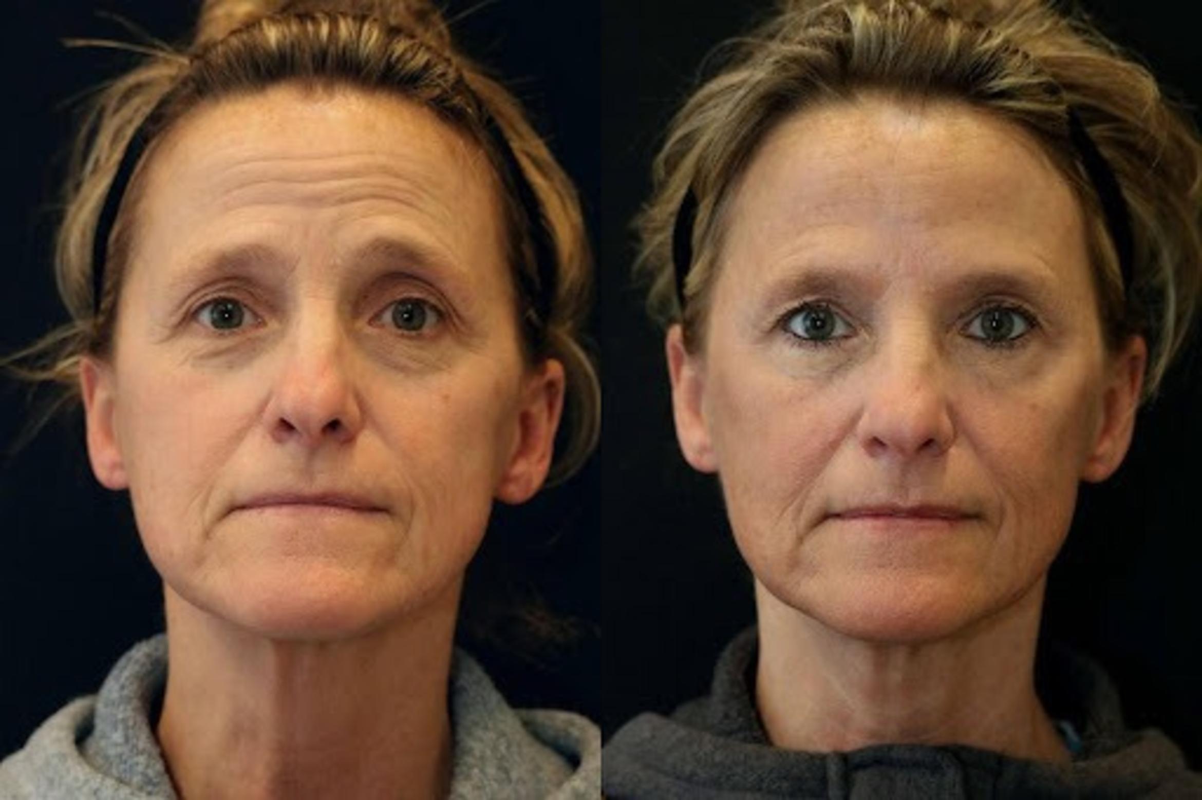 Before & After Fractionated CO2 (DOT) Laser Case 268 View 1 View in Santa Rosa, California