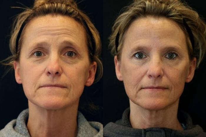 Before & After Fractionated CO2 (DOT) Laser Case 268 View 1 View in Santa Rosa, California