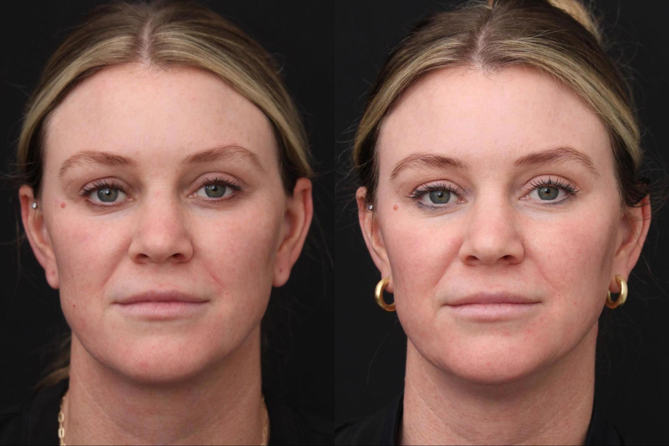 Before & After Fractionated CO2 (DOT) Laser Case 384 View 1 View in Santa Rosa, California