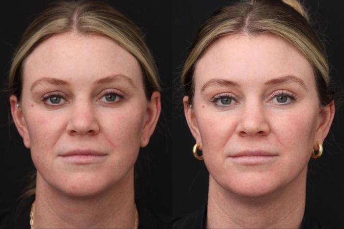 Before & After Fractionated CO2 (DOT) Laser Case 384 View 1 View in Santa Rosa, California