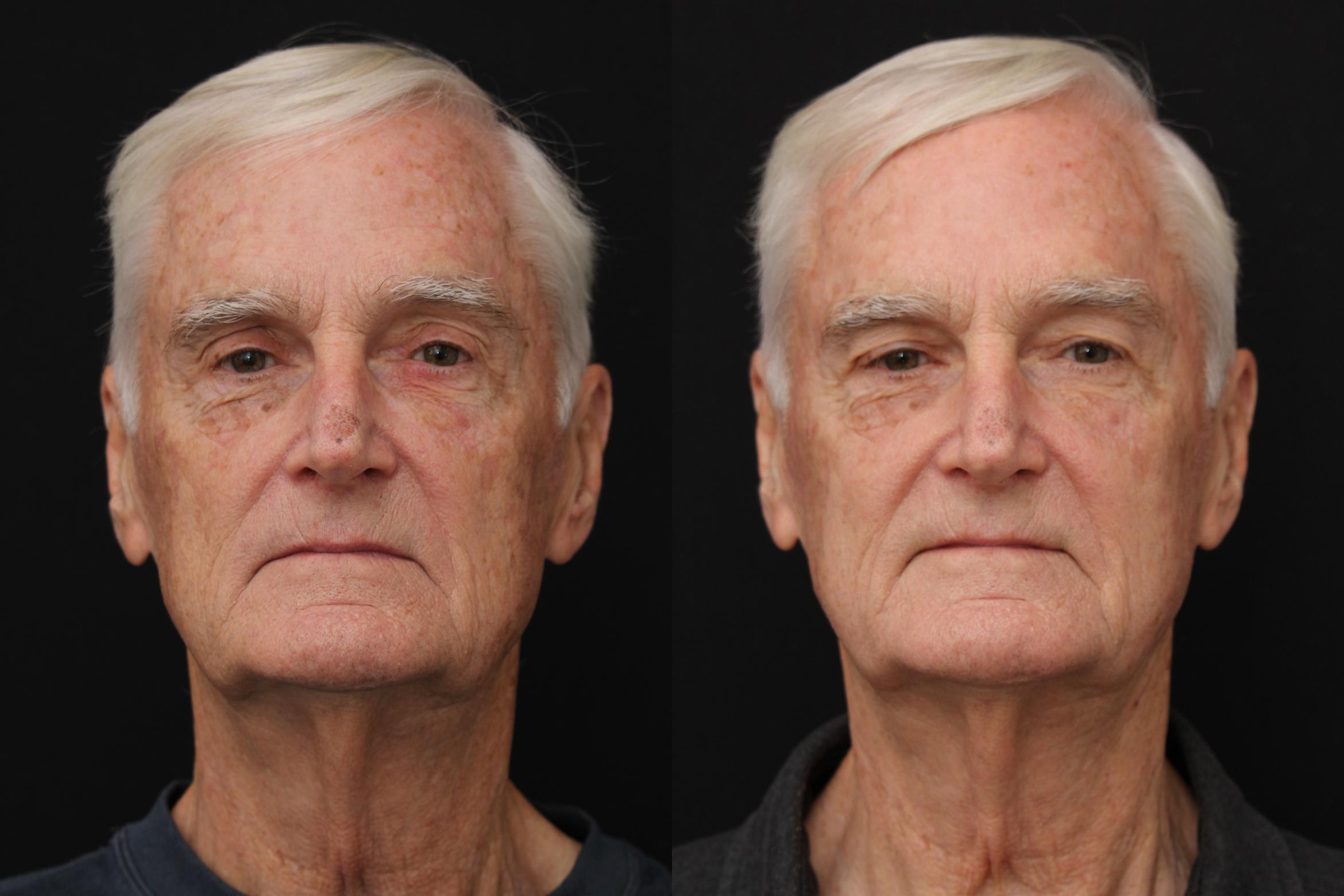Before & After Fractionated CO2 (DOT) Laser Case 429 Front View in Santa Rosa, California