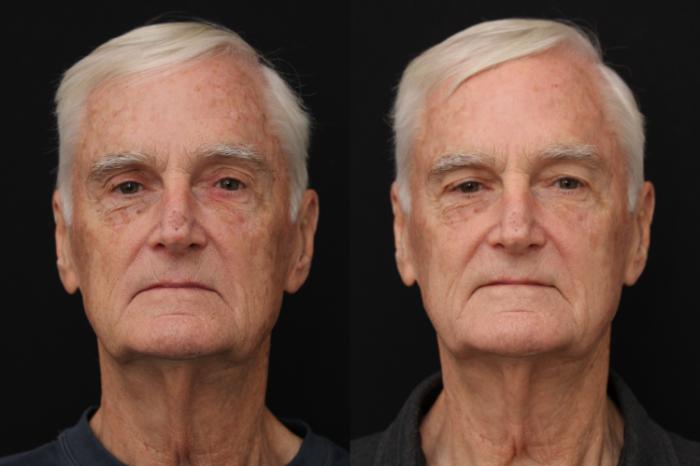 Before & After Fractionated CO2 (DOT) Laser Case 429 Front View in Santa Rosa, California