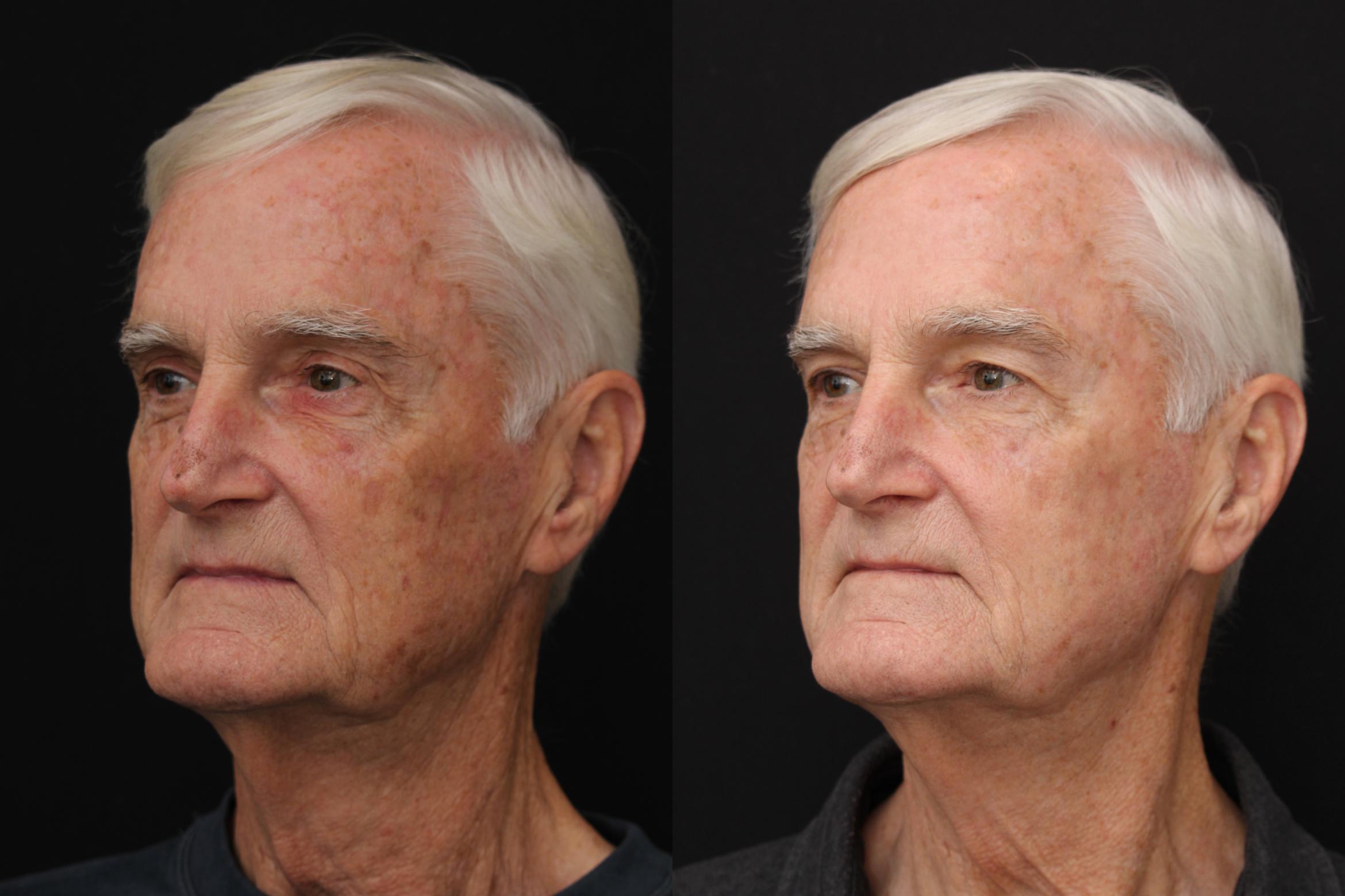 Before & After Fractionated CO2 (DOT) Laser Case 429 Left Side View in Santa Rosa, California