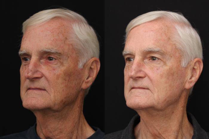 Before & After Fractionated CO2 (DOT) Laser Case 429 Left Side View in Santa Rosa, California