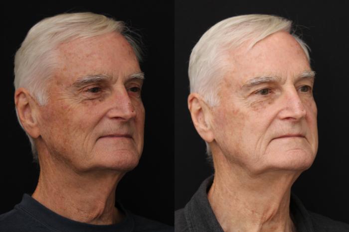 Before & After Fractionated CO2 (DOT) Laser Case 429 Right Side View in Santa Rosa, California