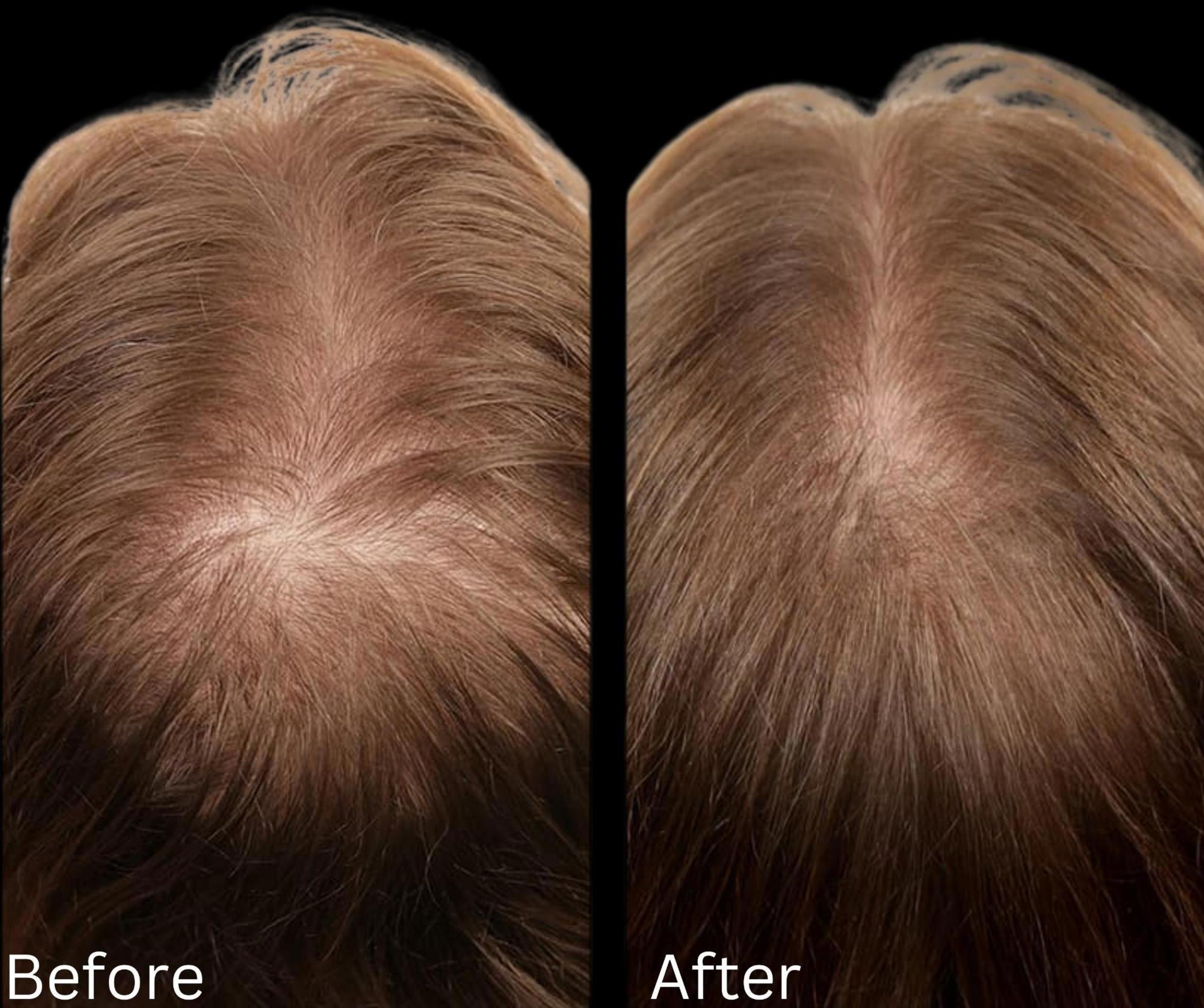 Before & After Hair Growth & Health Case 120 View 1 View in Santa Rosa, California