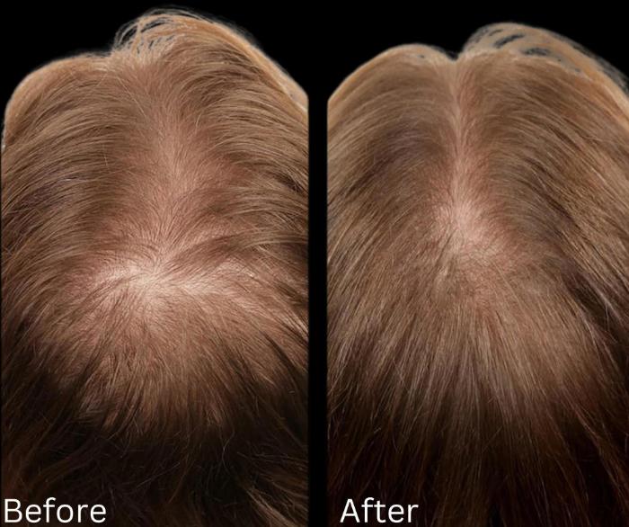Before & After Hair Growth & Health Case 120 View 1 View in Santa Rosa, California