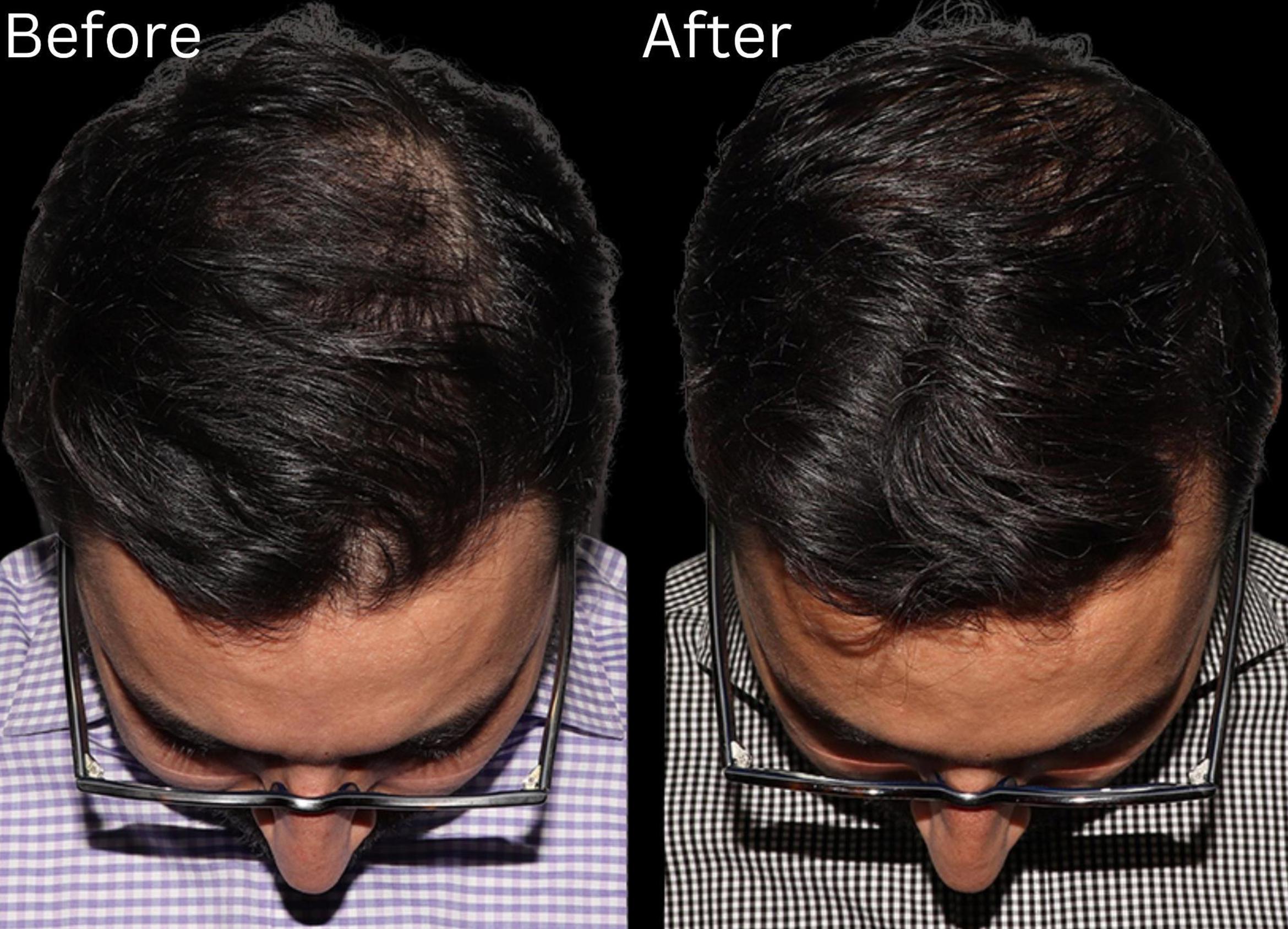 Before & After Hair Growth & Health Case 182 View 1 View in Santa Rosa, California