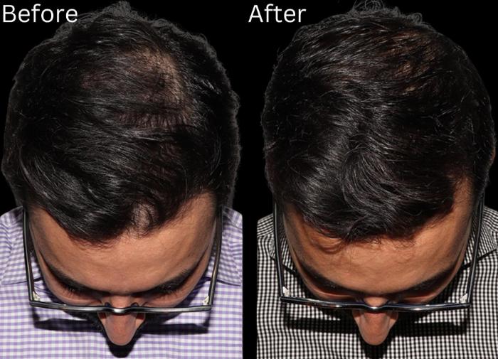 Before & After Hair Growth & Health Case 182 View 1 View in Santa Rosa, California