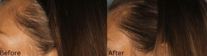 Before & After Hair Growth & Health Case 183 View 1 View in Santa Rosa, California