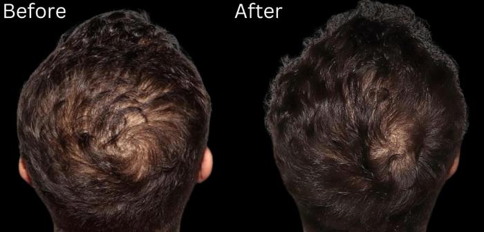 Before & After Hair Growth & Health Case 184 View 1 View in Santa Rosa, California