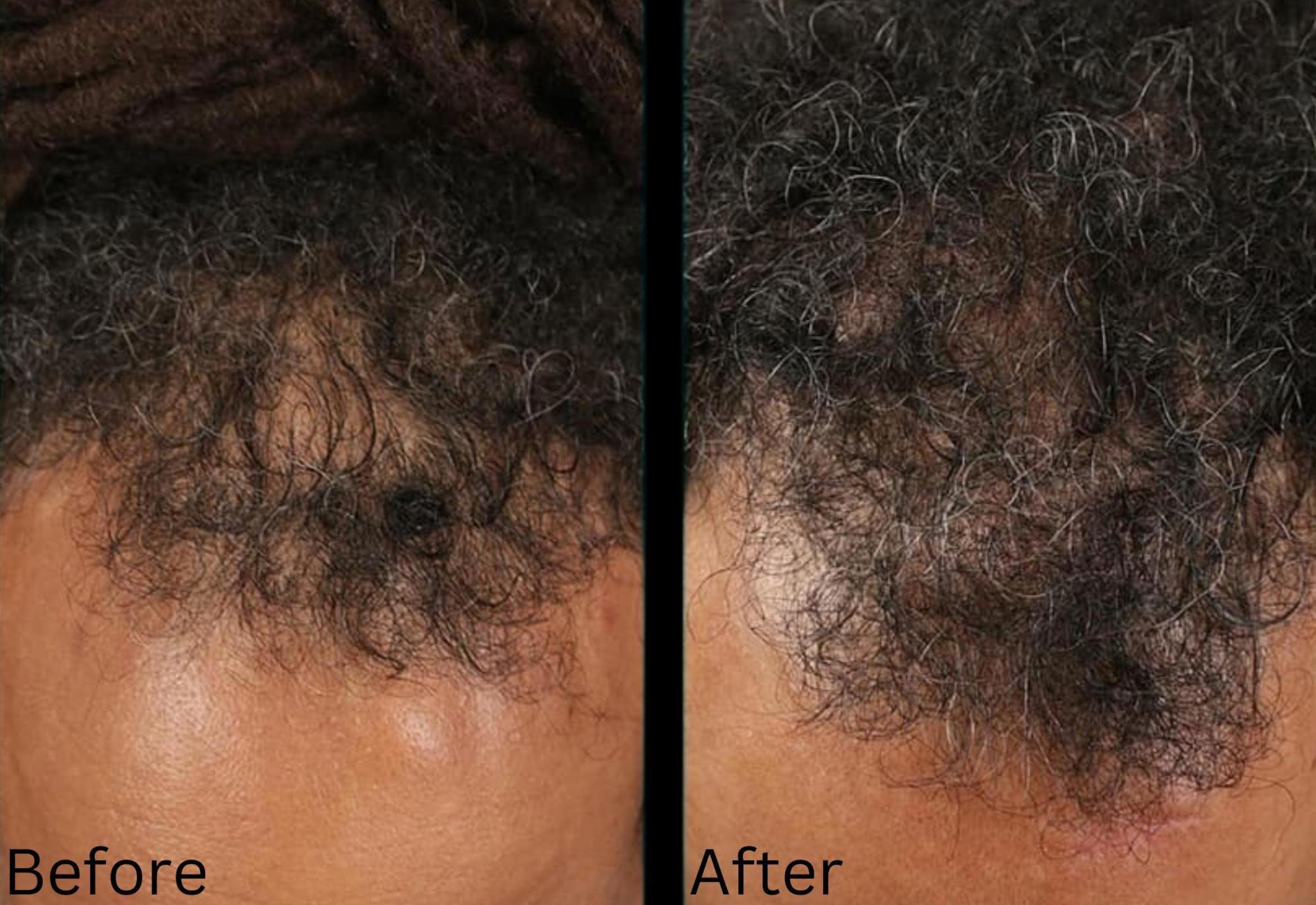 Before & After Hair Growth & Health Case 185 View 1 View in Santa Rosa, California