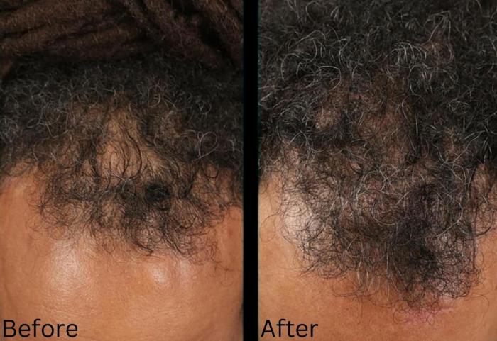 Before & After Hair Growth & Health Case 185 View 1 View in Santa Rosa, California