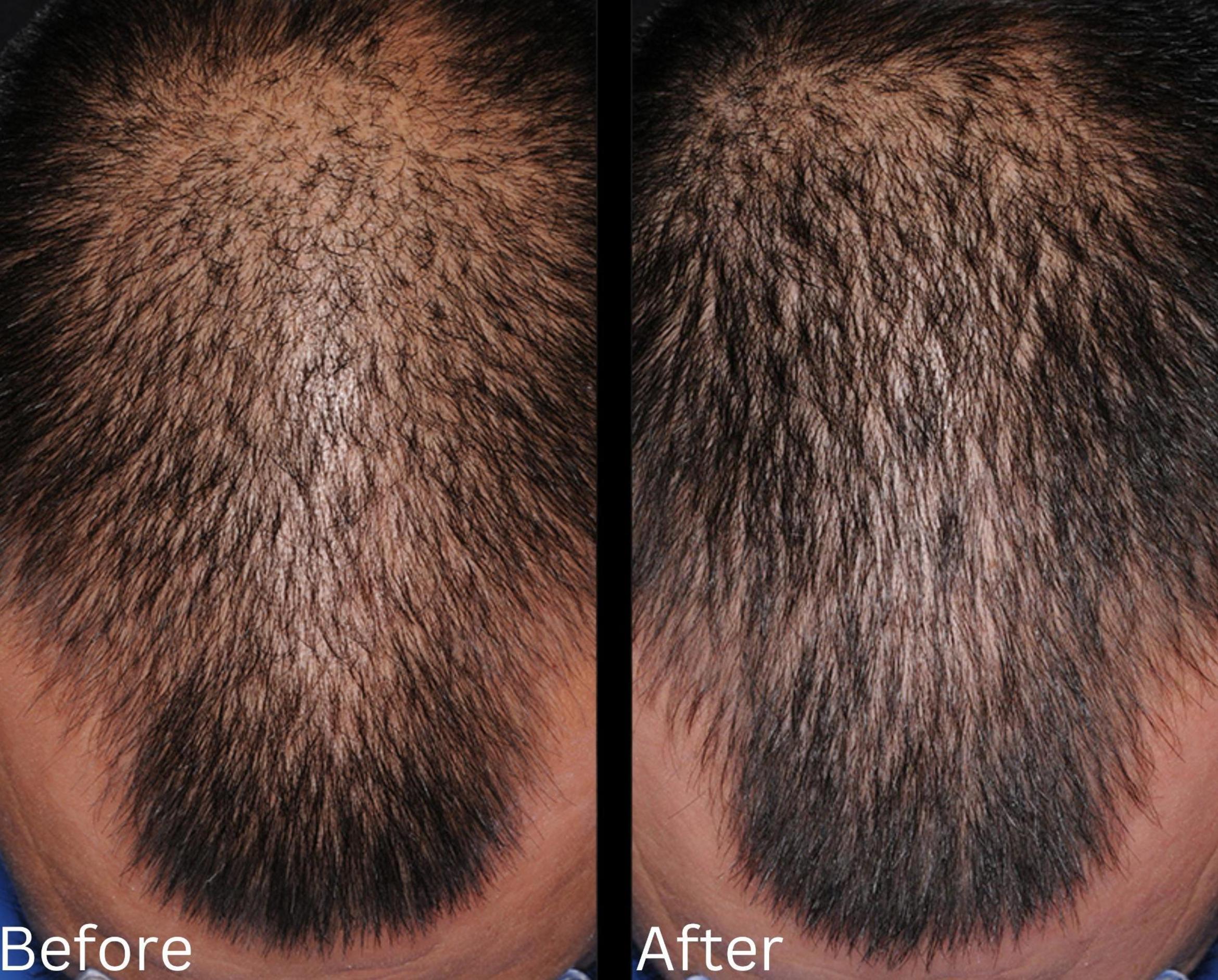 Before & After Hair Growth & Health Case 187 View 1 View in Santa Rosa, California