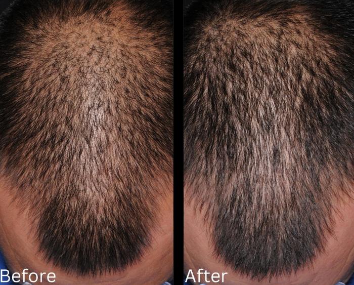 Before & After Hair Growth & Health Case 187 View 1 View in Santa Rosa, California