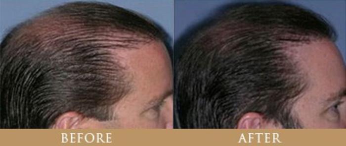 Before & After Hair Transplant Case 119 View 1 View in Santa Rosa, California