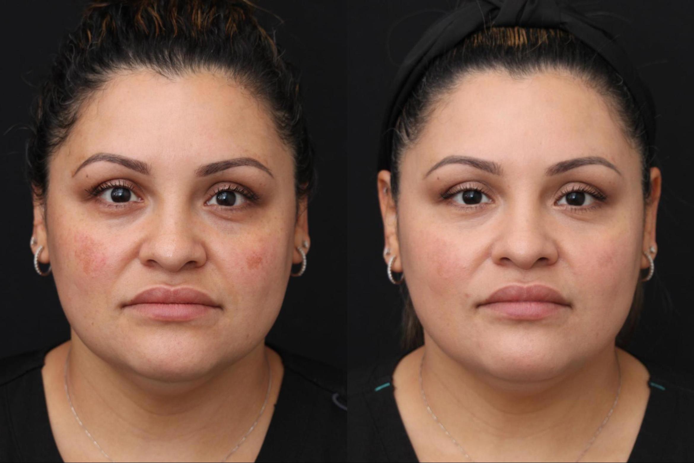 Before & After Intense Pulsed Light Case 382 View 1 View in Santa Rosa, California
