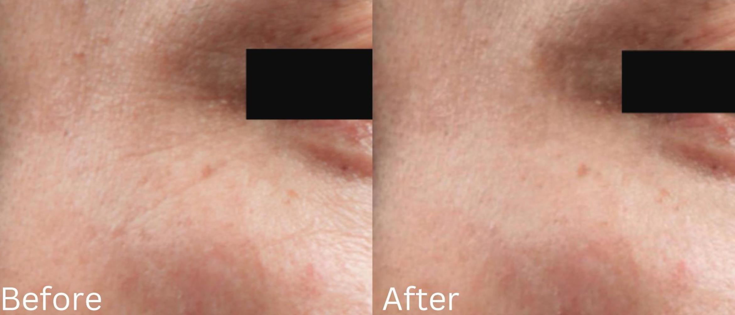 Before & After IntraCel Case 188 View 1 View in Santa Rosa, California
