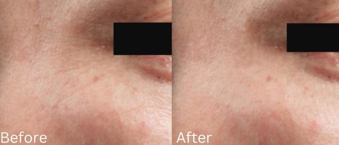 Before & After IntraCel Case 188 View 1 View in Santa Rosa, California