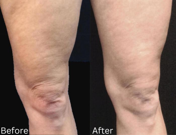 Before & After IntraCel Case 189 View 1 View in Santa Rosa, California