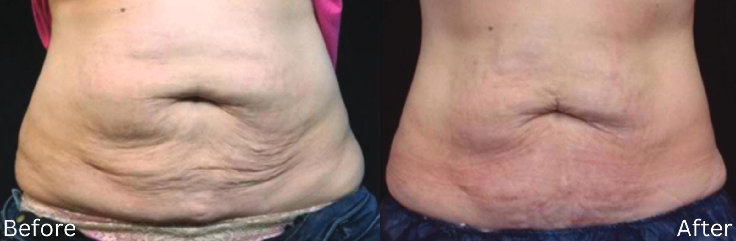 Before & After IntraCel Case 190 View 1 View in Santa Rosa, California