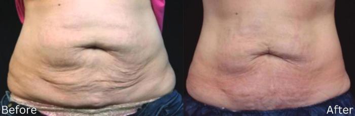 Before & After IntraCel Case 190 View 1 View in Santa Rosa, California