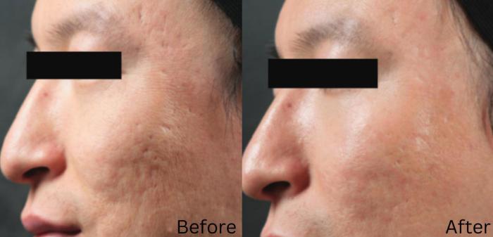Before & After IntraCel Case 193 View 1 View in Santa Rosa, California