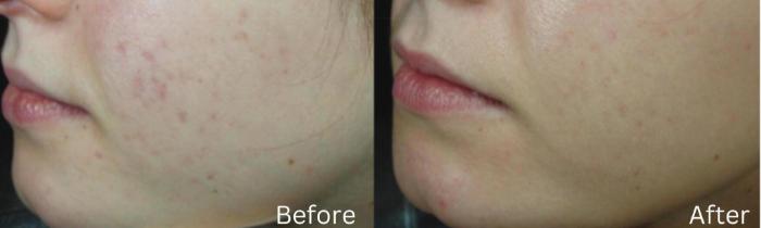 Before & After IntraCel Case 194 View 1 View in Santa Rosa, California