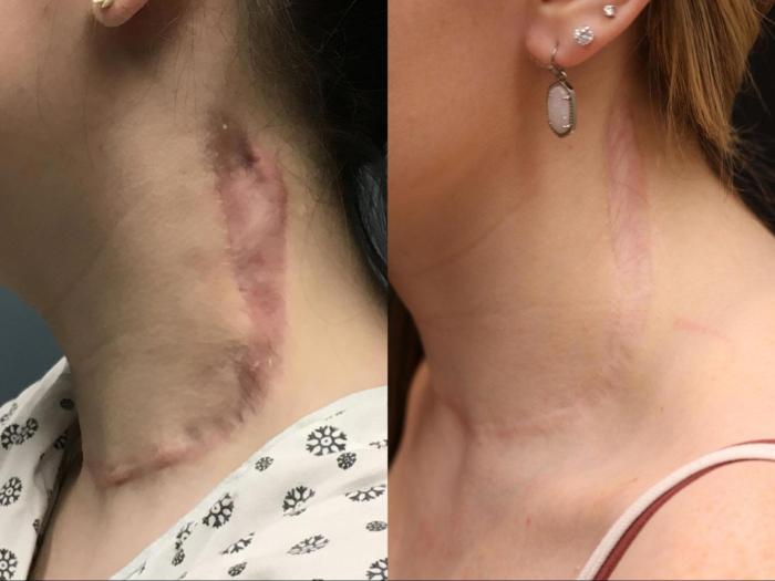 Before & After IntraCel Case 383 View 1 View in Santa Rosa, California