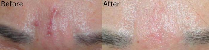 Before & After IntraCel Case 4 View 1 View in Santa Rosa, California