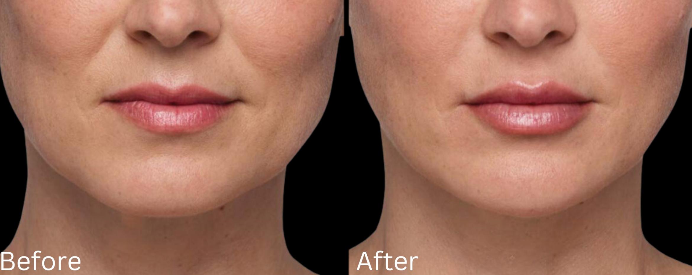 Before & After Juvederm Filler Case 309 View 1 View in Santa Rosa, California