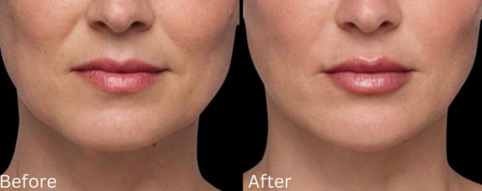 Before & After Juvederm Filler Case 309 View 1 View in Santa Rosa, California