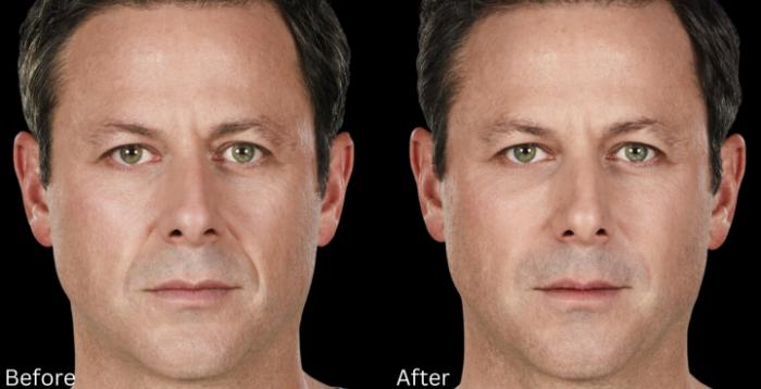 Before & After Juvederm Filler Case 310 View 1 View in Santa Rosa, California