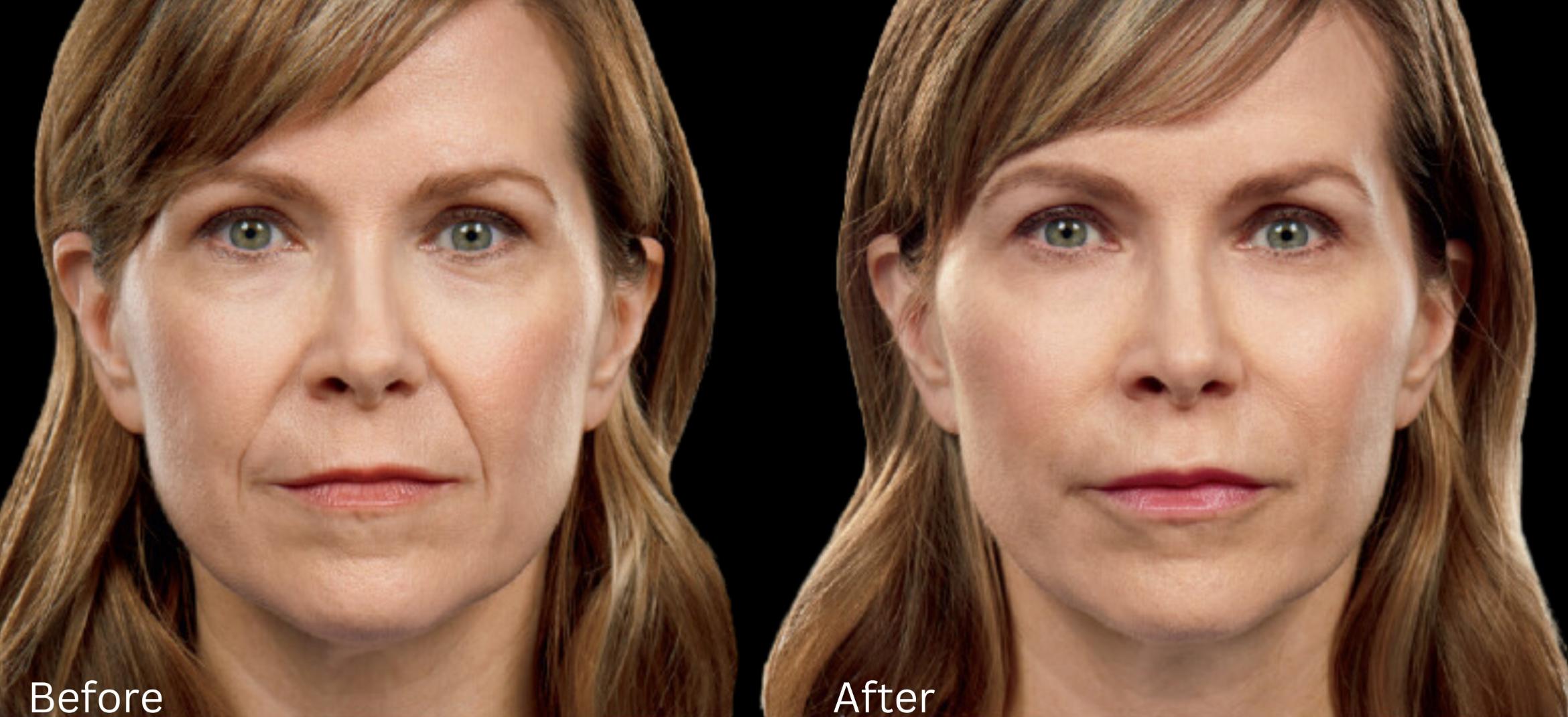 Before & After Juvederm Filler Case 311 View 1 View in Santa Rosa, California