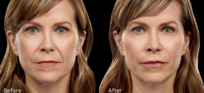 Before & After Juvederm Filler Case 311 View 1 View in Santa Rosa, California