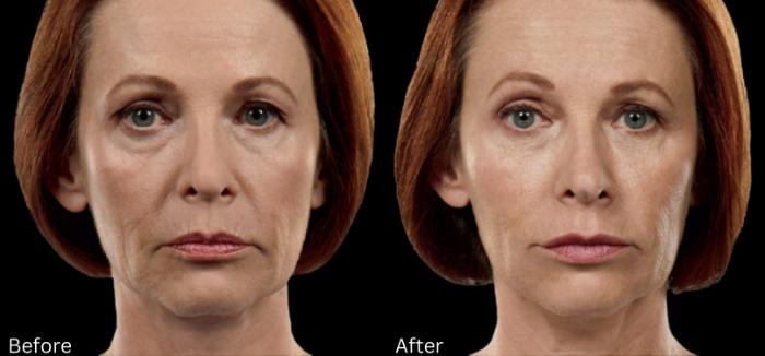 Before & After Juvederm Filler Case 312 View 1 View in Santa Rosa, California