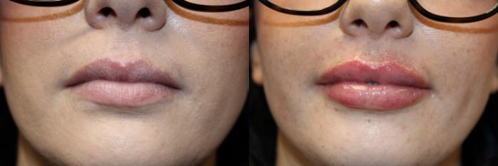 Before & After Juvederm Filler Case 424 Front View in Santa Rosa, California