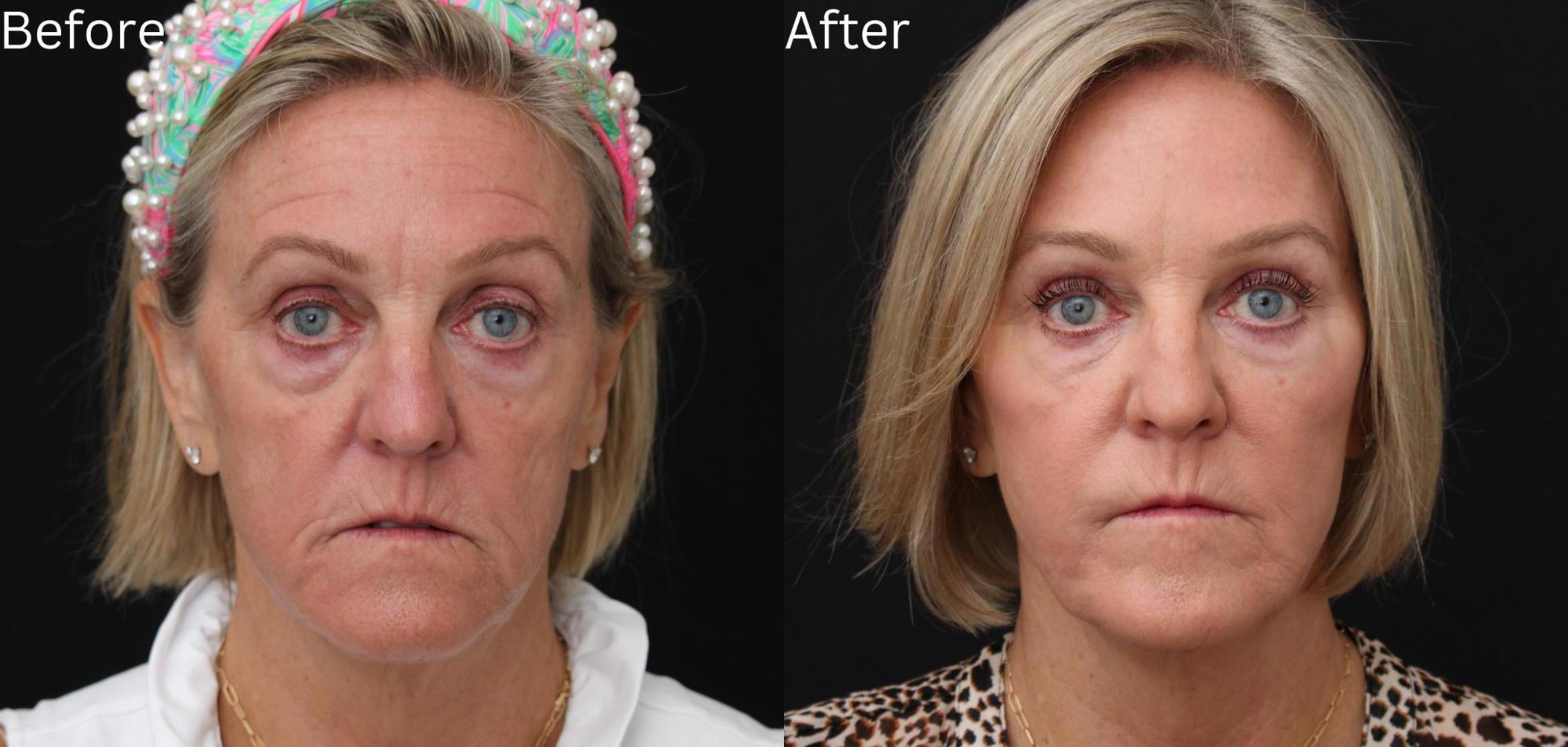 Before & After Juvederm Filler Case 60 View 1 View in Santa Rosa, California