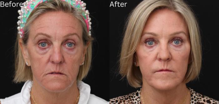 Before & After Juvederm Filler Case 60 View 1 View in Santa Rosa, California