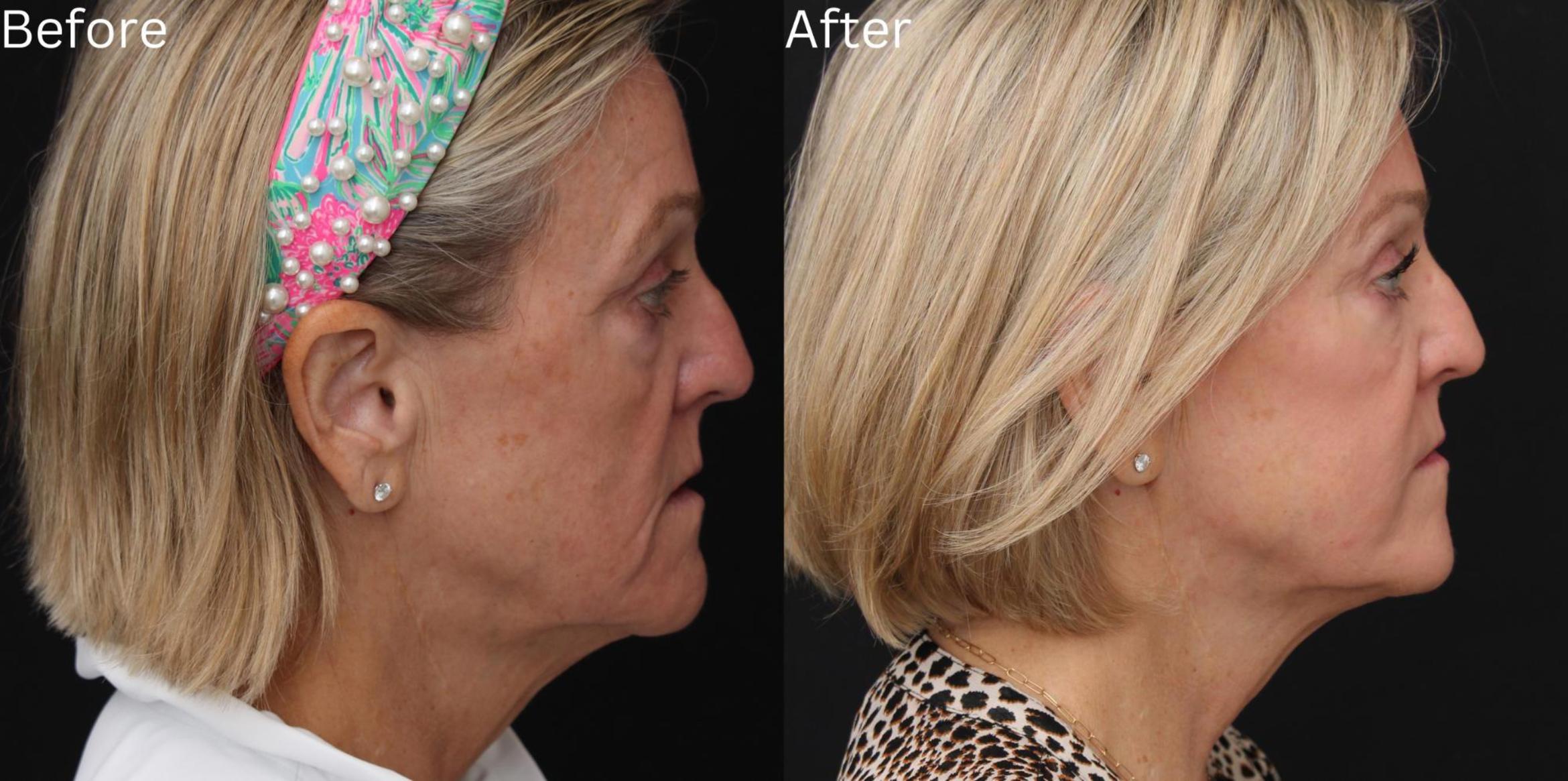 Before & After Juvederm Filler Case 60 View 3 View in Santa Rosa, California